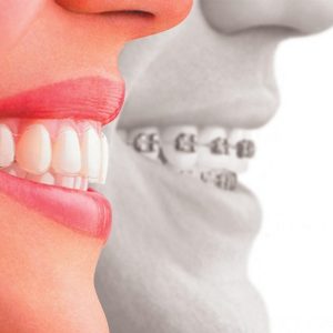 Invisalign2.jpg